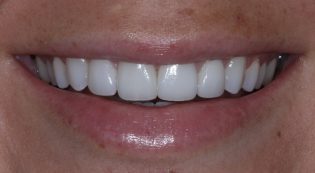 Teeth Treatments - Smile Virtual After Face