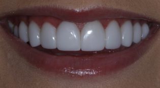 Teeth Treatments - Smile Virtual After Face