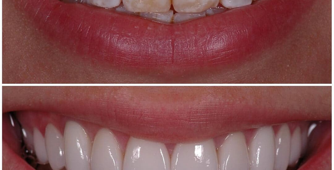 Smile Transformation by Smile virtual