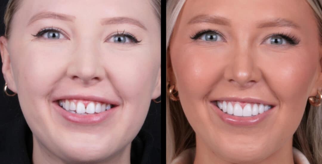 Veneers by Smile Virtual